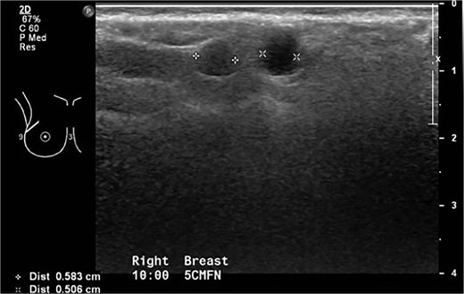 October 2015: Ultrasonography showing snowstorm appearance secondary to free silicone injection, with round cystic lesions scattered throughout both breasts representing silicone granuloma.