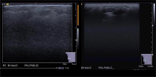 August 2020: Ultrasonography images showing marked snowstorm appearance secondary to silicone injection with multiple silicone deposits and granulomata in superficial breast tissue.