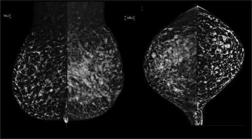 August 2020: Mammography images: Mediolateral oblique views (left), craniocaudal views (right).