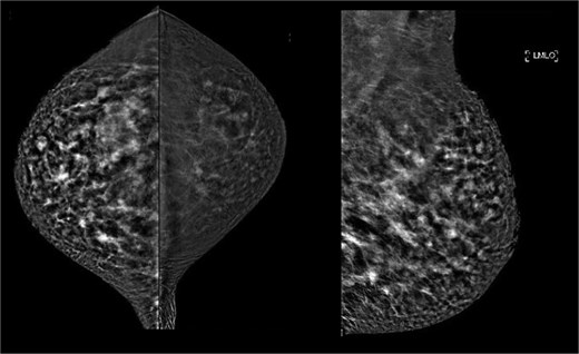 August 2020: Limited contrast enhanced spectral mammography showing enhancing mass in lateral half of right breast (right mediolateral oblique view not available—Mammogram machine unable to expose despite repeated attempts).