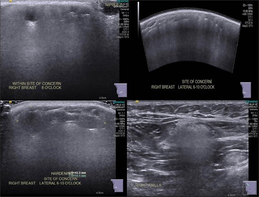 June 2021: Repeat ultrasonography showing silicone granulomata.