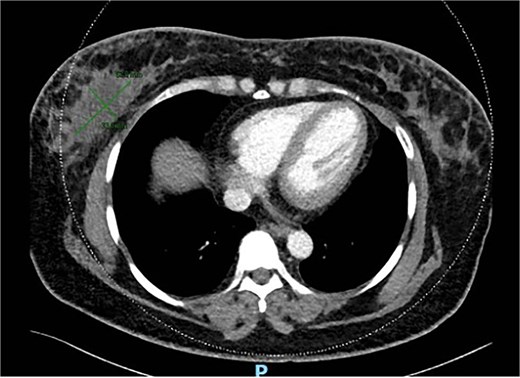 September 2021: Staging CT scan.