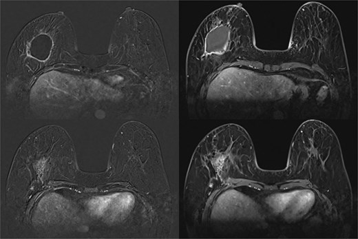 September 2021: MRI breast.