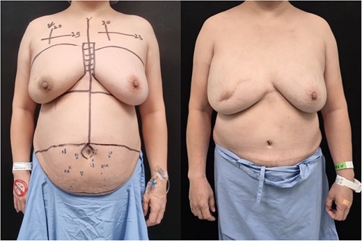 Photo taken before nipple-sparing mastectomy and DIEP flap reconstruction (left); taken 1 year after surgery (right).