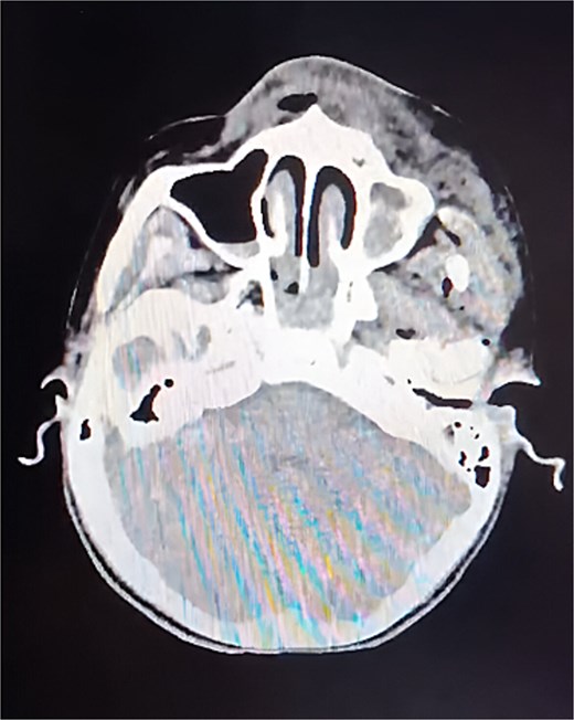 CT of the skull, axial slice. A cranial base fracture is evident, with bleeding at the level of the maxillary sinus. Small areas of bleeding are also observed in the intraparenchymal region.