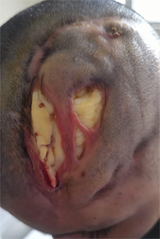 Preoperative image. Tissue lysis at the scalp level, exposing the cement prosthesis or previous surgical procedure.