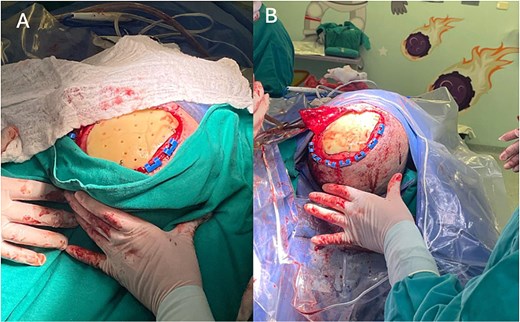 Surgical procedure. (A) Placement and fixation of the PMMA prosthesis with titanium plates and screws. (B) Layered closure and creation of a rotation fasciocutaneous flap.