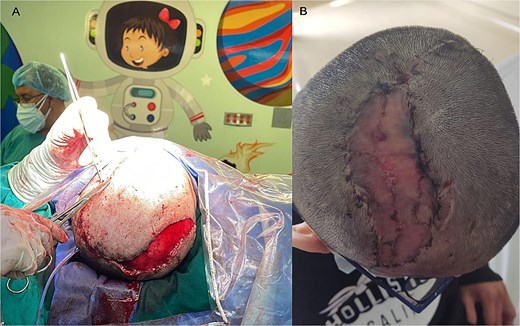 Coverage of PMMA prosthesis. (A) A large-dimensional rotational skin flap was created to cover the entire surface of the prosthesis and osteosynthesis material. Skin grafts were then performed over the residual donor area. (B) Postoperative follow-up for suture removal, 15 days later, observing complete viability of the flap and graft area.