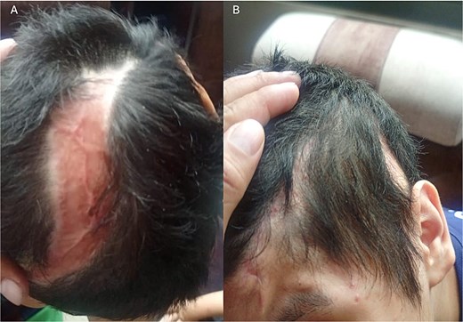 Postoperative follow-up, 4 months after surgery. (A) Flap and graft area with adequate healing; an alopecic area is visible, which will be treated one year after surgery for the placement of tissue expanders. (B) Site of prosthesis placement with an appropriate healing process.