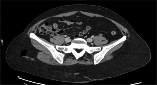 Preoperative pelvic CT scan showing right gluteal subcutaneous emphysema.