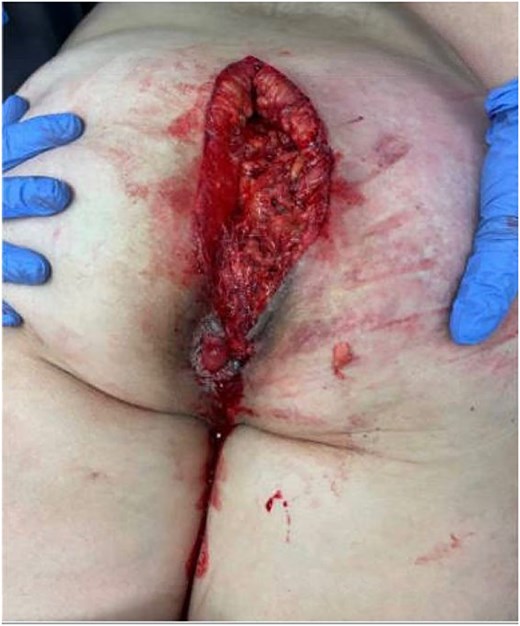 Preoperative wound.