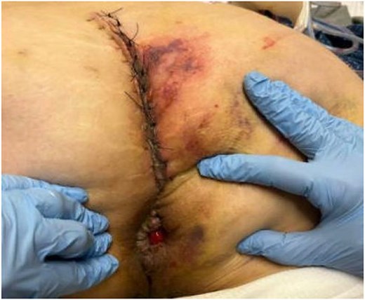 Wound at discharge on post-op day 4. Single prolapsed grade 4 internal hemorrhoid present.