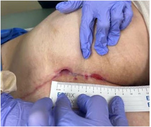 Wound 8 weeks after take back procedure.