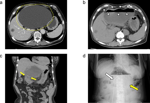 (a) Enhanced CT images findings obtained in the examination by the patient’s primary care physician. A 16-cm hepatic cyst in the left hepatic lobe area was observed. Dotted line: The hepatic cyst. (b, c) Plain CT images findings obtained at the patient’s hospitalization. (b) This axial section shows the large hepatic cyst in left hepatic lobe area, which was collapsed and contained air bubbles. There were no findings of free air or leakage into the peritoneal cavity. Arrowheads: The air bubbles of collapsed large hepatic cyst. (c) A low-density area between the hepatic cyst and the duodenum with a suspicion of a fistulous tract can be seen on this coronal section. Arrows: The low-density area between the hepatic cyst and the duodenum. (d) An abdominal X-ray finding after the percutaneous catheter aspiration of the hepatic cyst with a 7Fr pig-tail catheter (left arrow). Right arrow: The nasogastric tube.