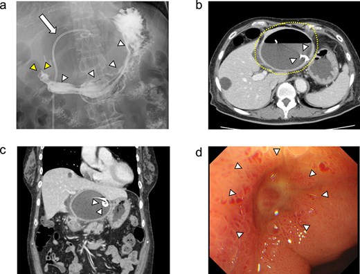 The upper gastrointestinal contrast examination findings on day 13 of the patient’s hospital admission. (a) There was no obvious fistulous tract between the hepatic cyst and the duodenum. arrowheads: The stomach, arrowheads: The duodenum. arrow: The 7Fr pig-tail catheter. (b, c) Enhanced CT images findings on 20 day of admission. (b) Axial section. A shrunken hepatic cyst with a thickened cyst wall was observed. Dotted line: The large hepatic cyst. Arrowheads: The 7Fr pig-tail catheter. (c) Coronal section. A a low-density area was observed between the hepatic cyst and the duodenum, suspected of being a fistulous tract. Arrows: The low-density area between the hepatic cyst and the duodenum. Arrowheads: The 7Fr pig-tail catheter. (d) An upper gastrointestinal endoscopy on admission day 21 showed an ulcer scar at the anterior aspect of the duodenum bulb without obvious fistulous orifice. Arrowheads: The ulcer scar at the anterior aspect of the duodenum bulb.