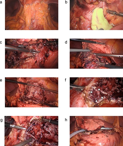 (a–h) Operative findings during the patient’s laparoscopic surgery. (a) Inflammatory tissue adhesions were observed on the peritoneum, omentum, and hepatic cyst. (b) A large amount of purulent fluid was discharged from the opened hepatic cyst. (c, d) The hepatic cyst wall was resected at the junction of the hepatic cyst and the liver parenchyma using the LigaSure™ vessel sealing system (Medtronic, Dublin, Ireland). (e) The laparoscopic hepatic cyst deroofing was completed. (f) A depression in the lumen of the fenestrated cyst near the duodenal bulb was observed, which was thought to be the penetration site between the hepatic cyst and the duodenum. Arrowheads: The depression in the lumen of the fenestrated cyst near the duodenal bulb. (g) The depression was closed using a 3–0 Vicryl® suture (Ethicon, Cornelia, GA, USA). (h) After the peritoneal lavage, one closed drain was placed at the site of the fenestrated hepatic cyst.