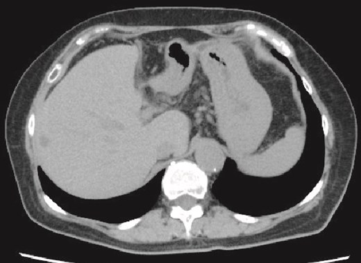 Plain CT image 6 months after the patient’s surgery. There was no evidence of hepatic cyst recurrence.