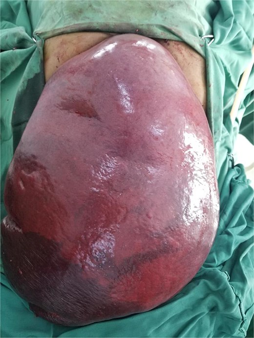 Intraoperative image showing the giant spleen delivered through the peritoneal cavity following careful dissection and adhesiolysis.