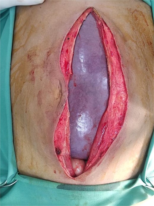 Intraoperative image demonstrating the giant splenomegaly compressing the adjacent intraabdominal organs.