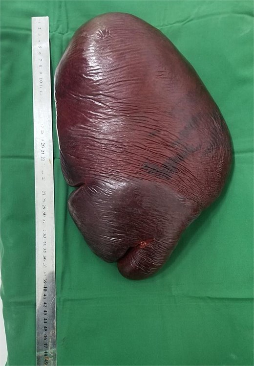 Postoperative image showing the excised giant spleen measuring 40 cm in diameter.