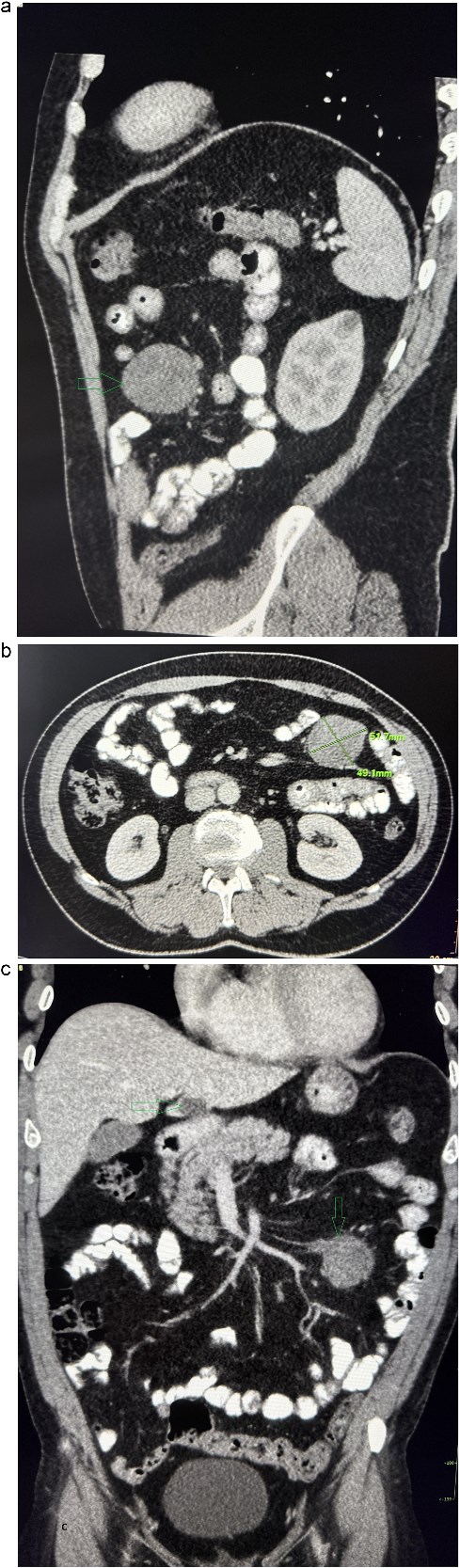 Contrast-enhanced abdominal CT. (a) The sagittal section presents a tumor mass at the root of the mesentery in the left mesogastrium. (b) The axial section presents a tumor mass measuring 52×49 mm in diameter. (c) The coronal section presents a tumor mass at the root of the mesentery in the left mesogastrium and suspected metastatic liver lesion.
