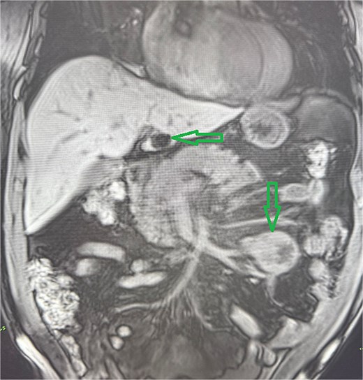 Abdominal MRI, T1 sequency. The coronal section presents a tumor mass at the root of the mesentery in the left mesogatrium and the liver cyst.