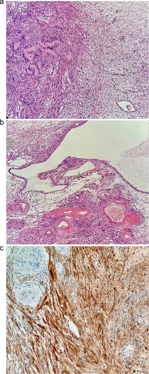 (a) Typical biphasic appearance of schwannoma. The left half of the image shows a compact area with a rhythmic arrangement of nuclei and Verocay bodies (Antoni a). On the right, a sparse hypocellular area is visible (Antoni B)—HeEo ×100. (b) Ancient changes in schwannoma, where pseudocystic transformation with siderofages is evident as a sign of older hemorrhage and hyalinized tumor vessels—HeEo ×100. (c) Detailed strong diffuse positivity (brown cells) of tumor cells in immunohistochemical reaction with antibody against the S100 protein ×200.