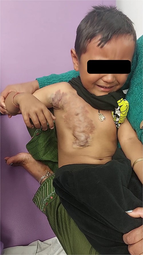 A large venous malformation on the right anterior chest wall, visibly enlarging when the child cries.