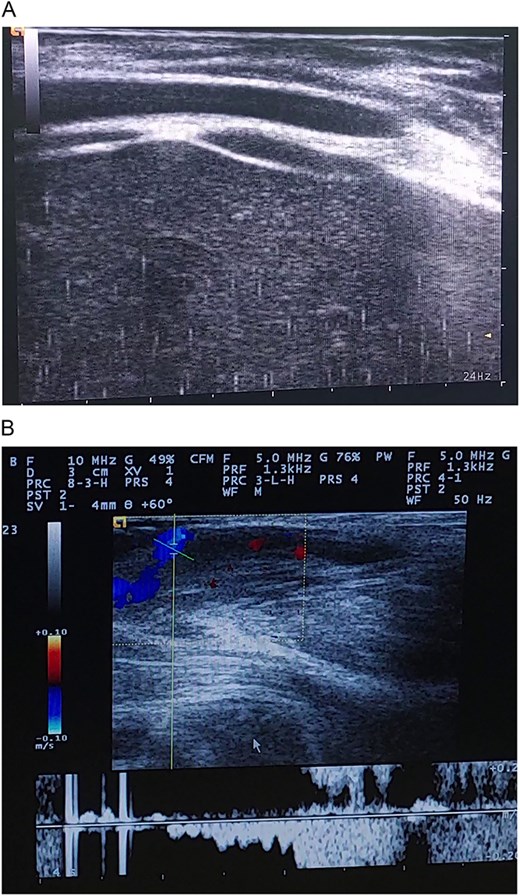 (A and B) Ultrasound images demonstrating cystic vascular spaces with non-pulsatile venous flow.