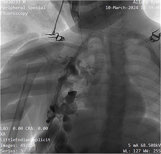 Fluoroscopy image showing contrast administration into the malformation, confirming its slow-flow nature, and drainage pattern.
