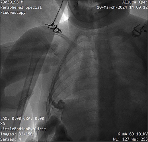 Image showing sclerotherapy administration through the same needle used for contrast injection, effectively ``washing out'' the contrast while sclerosing the venous malformation.