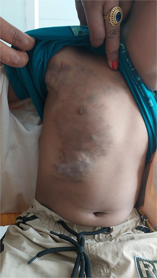 Patient at 2-month follow-up demonstrating significant resolution of the venous malformation.