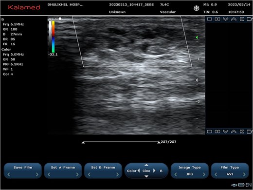 Ultrasound images at 2-month follow-up showing sclerosed vascular channels without flow.