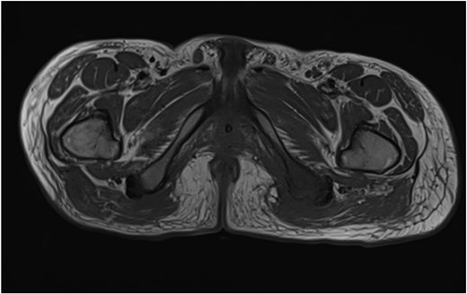 Axial MRI image demonstrating loss of normal T1 bone marrow signal is demonstrated involving the left ischial tuberosity. Findings in keeping with osteomyelitis.