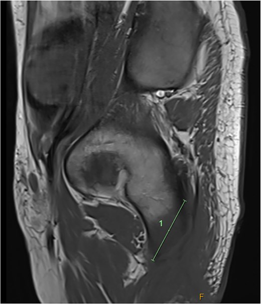 Sagittal MRI imaging demonstrating bony signal changes extend to involve the inferior pubic ramus medially.