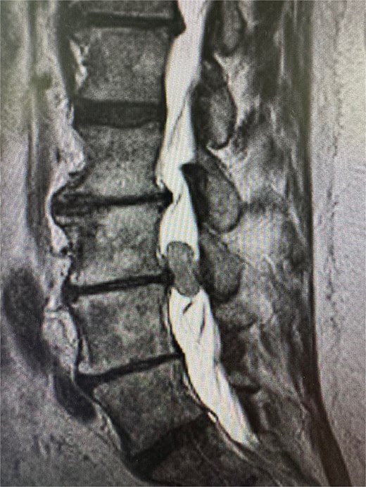 Sagittal T2-weighted MRI of the lumbar spine demonstrating a well-circumscribed intradural extramedullary mass measuring 0.9 × 1.4 × 1.9 cm at the L3–L4 level. The lesion exhibits intermediate signal intensity.