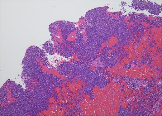 H&E, 10×. The biopsy shows sheets of small round blue cells admixed with blood and fibrous tissue.