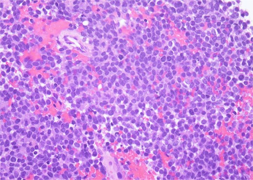 H&E, 40×. The neoplastic cells have scant cytoplasm, finely stippled chromatin, and inconspicuous nucleoli. At high power, mitotic figures and apoptotic debris are visible.
