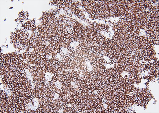 CD99, 20×. Immunohistochemical stain with CD99 demonstrates diffusely positive membranous staining of neoplastic cells.
