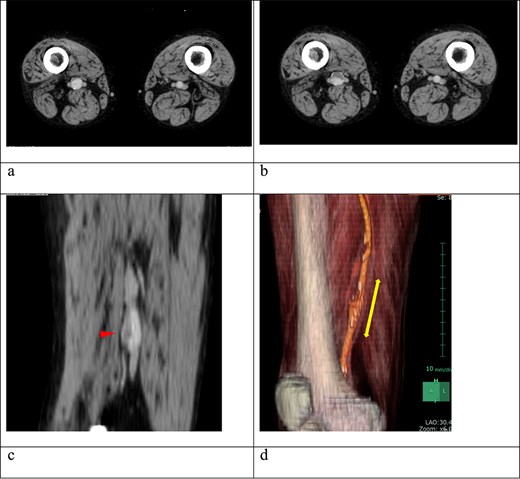 (a) Contrast-enhanced computed tomography (CT) performed 2 years earlier showed no thrombus in the right superficial femoral artery (SFA) aneurysm. (b) Despite ongoing oral anticoagulation therapy, preoperative contrast-enhanced CT revealed thrombus progression within the aneurysm, which was located 6 cm proximal to the knee and measured 15 mm in diameter. (c) The sagittal section of the contrast-enhanced CT showed an irregular thrombus on the inner wall of the aneurysm (arrow). (d) A three-dimensional-reconstructed contrast-enhanced CT identified the SFA aneurysm (arrow).
