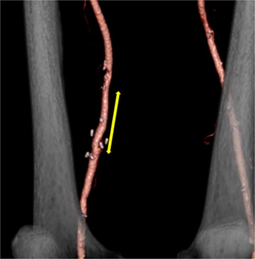 Postoperative contrast-enhanced CT revealed no aneurysm or stenosis formation at the reconstructed site (arrow) and optimal visualization of distal vessels.