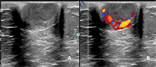 Ultrasonographic finding of left nipple mass, (A) before applying color Doppler mode and (B) after applying color Doppler mode.