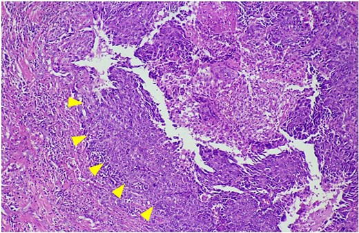 The histological features of hematoxylin and eosin staining shows clear cells and eosinophilic cells with vesicular nuclei and prominent nucleoli (arrowheads).