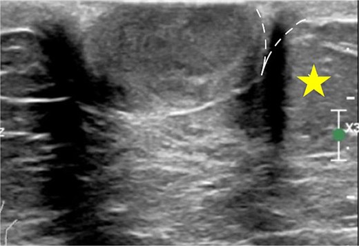 The claw sign. The ultrasonographic image shows a ‘claw’ of dermal tissue (dashed line) wrapping around the margin of the tumor and forming an acute angle. The star indicates the hypodermal layer.
