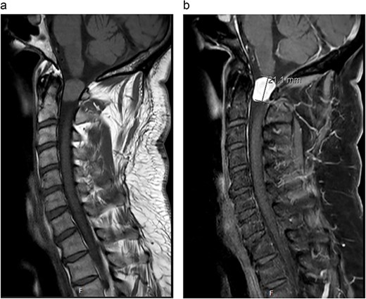 (a) Pre-operative sagittal MRI cervical spine T1-weighted image without contrast. (b) Pre-operative sagittal MRI cervical spine T1-weighted image with contrast.