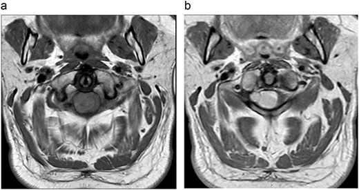 (a) Pre-operative axial MRI cervical spine T1-weighted image without contrast (across the C1 level). (b) Pre-operative axial MRI cervical spine T1-weighted image with contrast (across the C1 level).
