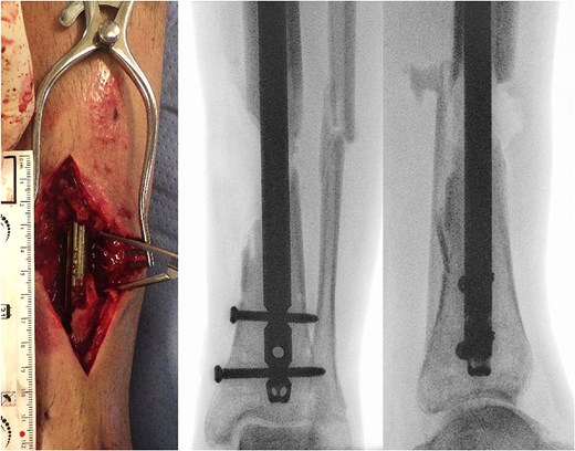 (a) Photography of intraoperative bone defect before graft cage implantation and (b) intraoperative X-rays of left lower extremity show segmental bone defect.