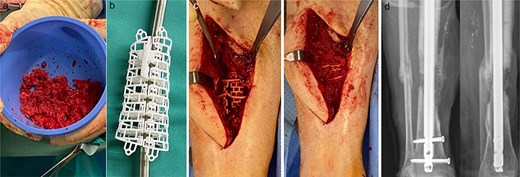 (a) RIA-harvested bone graft; (b) graft cage; (c) operation site with graft cage; (d) postoperative X-ray after graft cage implantation.