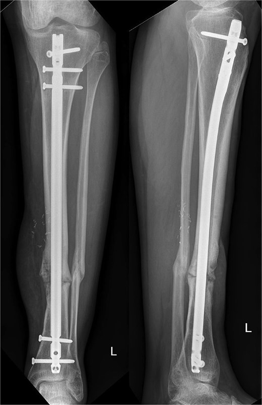 X-ray of lower extremity after 10 months.