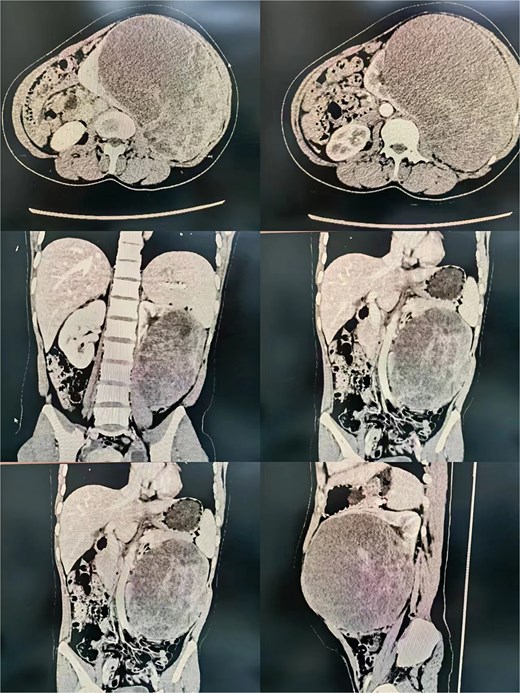 Radiological imaging of the left renal mass.